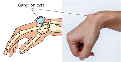 Ganglion Cyst Wrist, Foot, Finger - Treatment By Homeopathy