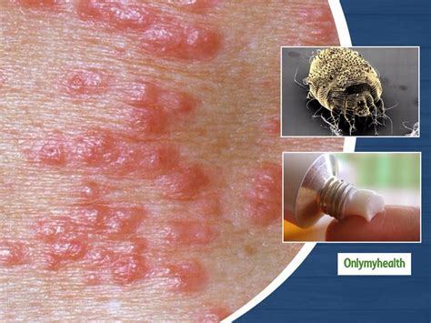 What Is Scabies? Learn About Its Causes, Symptoms And Treatment ...