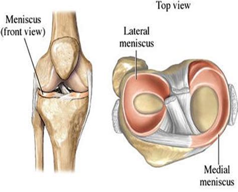 Meniscal Tears | Brisbane Knee and Shoulder Clinic | Dr MacgroartyBrisbane Knee and Shoulder Clinic