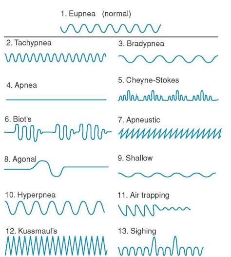 Cheyne Stokes Respirations Are Described as a