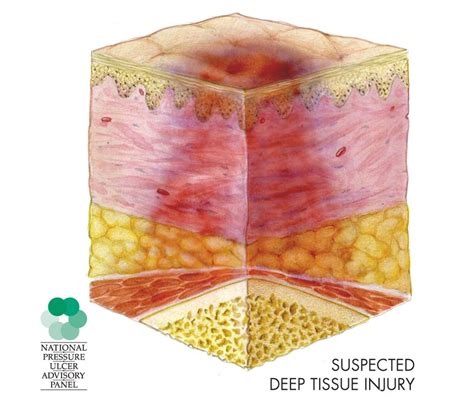 Deep Tissue Injury: What the Eye Can’t See