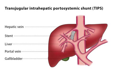 Esophageal Varices Anatomy