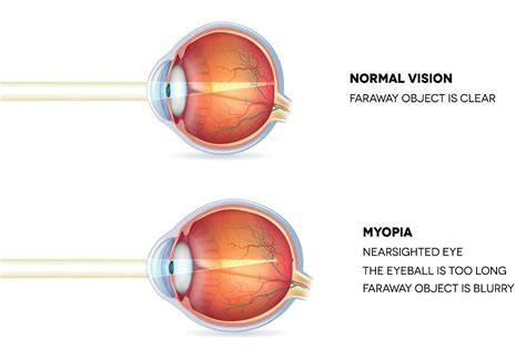 Does LASIK Treat Nearsightedness | Kalamazoo Ophthalmology | Portage - Kalamazoo Ophthalmology