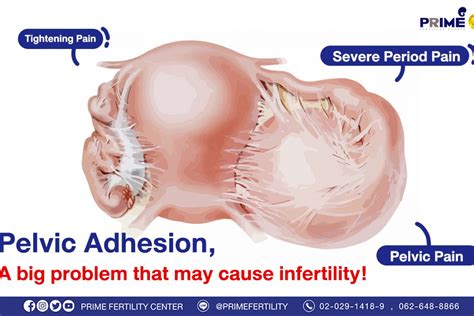 Pelvic Adhesion, A big problem that may cause infertility!