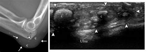 Tophaceous Gout of Olecranon Bursa overlying ulna - Note multiple soft ...