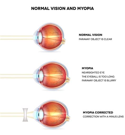 Nearsightedness and Farsightedness