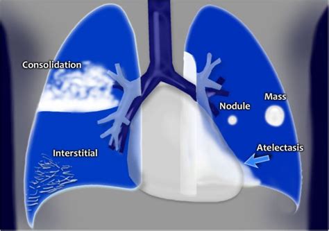 Chest X Ray Consolidation