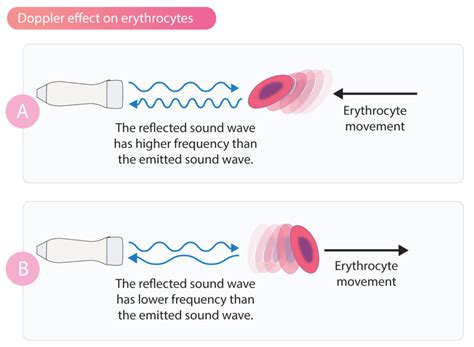 Doppler-Effekt und Doppler-Echokardiographie – EKG & ECHO