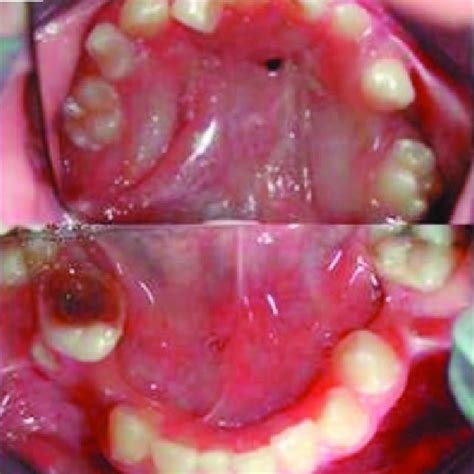 (PDF) Demirhan sydrome, a new sydrome: Fibular agenesis, cleft palate ...