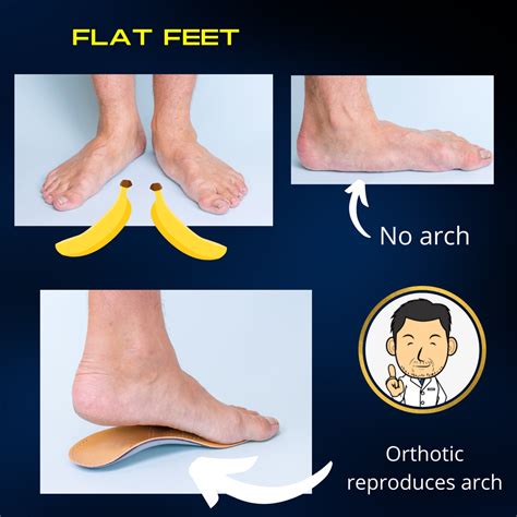 Treatment for Flat feet