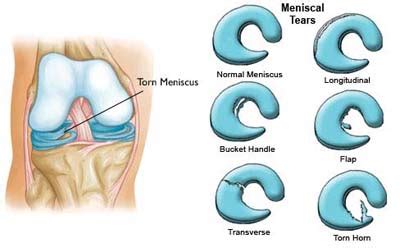 Non-surgical bucket handle meniscus tear treatments and repairs