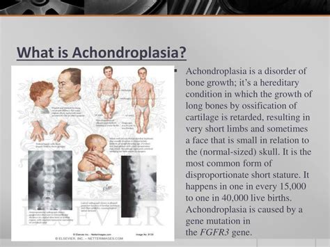 Dwarfism Symptoms