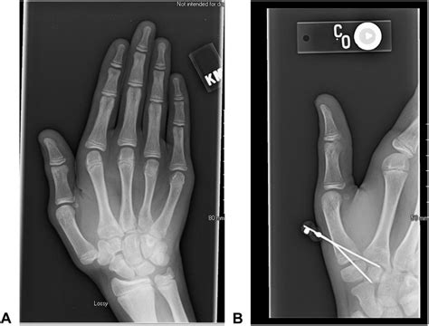 October 2013: Right CMC CRPP. The images represent the A preoperative... | Download Scientific ...