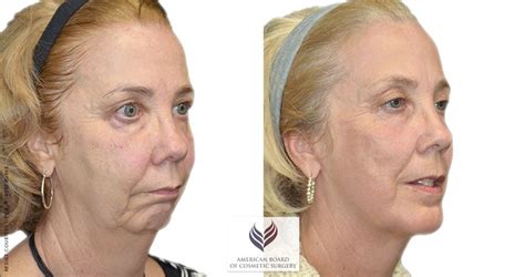 Facelift Procedure Guide | American Board of Cosmetic Surgery