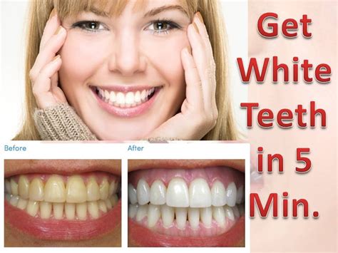 Teeth Treat: How do i get my teeth extremely white