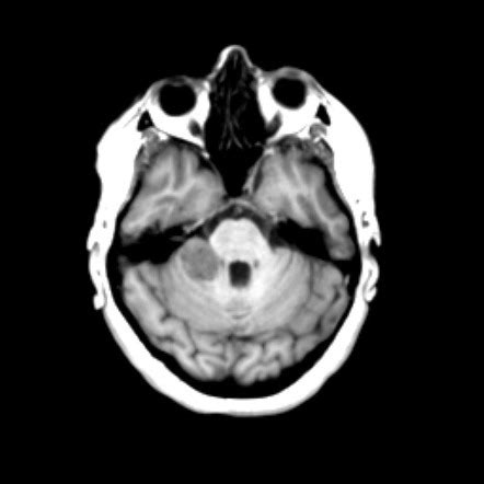 Tentorium cerebelli meningioma | Image | Radiopaedia.org