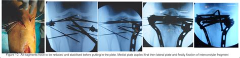 Tibia eminence fracture Archives - Trauma International