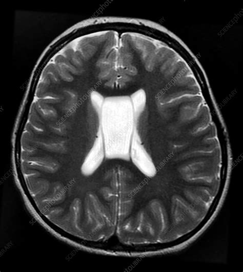 MRI Cavum Septum Pellucidum et Vergae - Stock Image - C043/0388 ...