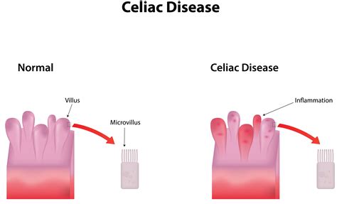 Celiac Disease System Disorder Template