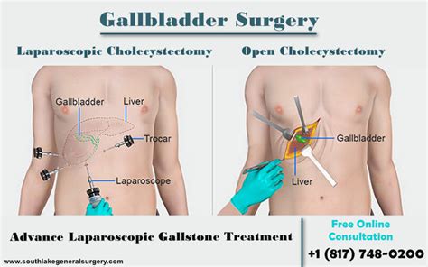 5 Signs that you should need Gallbladder Surgery - Southlake General ...