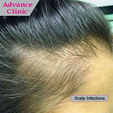 Scalp Infections: Ringworm, which is a very common fungal scalp infection, causes bulk hair loss ...