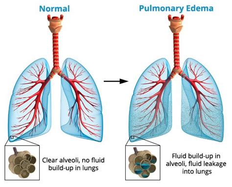 pulmonary edema - Google Search | NCLEX | Pinterest | Pulmonary edema, Medical and Respiratory ...