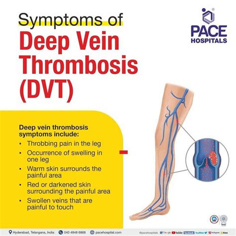 Deep Vein Thrombosis, DVT Symptoms, Causes And, 59% OFF