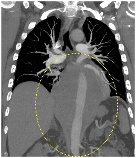 CTA chest image. A chest CTA revealed a large posterior mediastinal... | Download Scientific Diagram