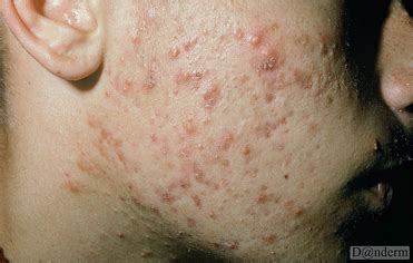 Acne | ADVATx