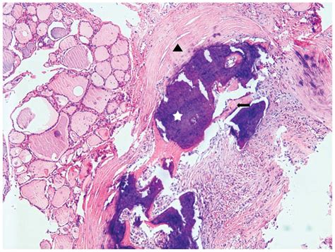 Osseous metaplasia with mature bone formation of the thyroid gland: Three case reports