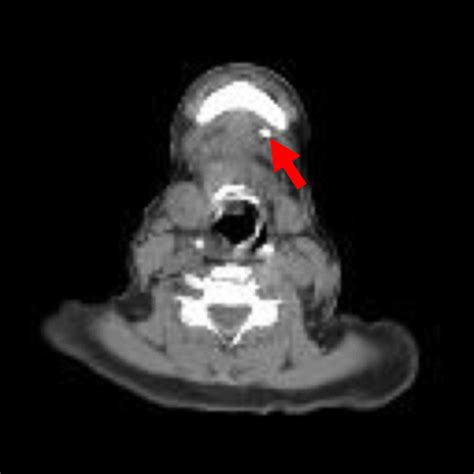 Stone in sublingual gland. Red arrow indicates stone in sublingual gland. | Download Scientific ...