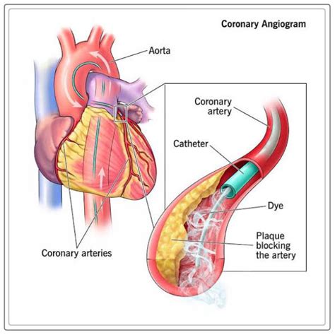 Coronary Angiography: Procedure - Engiomed