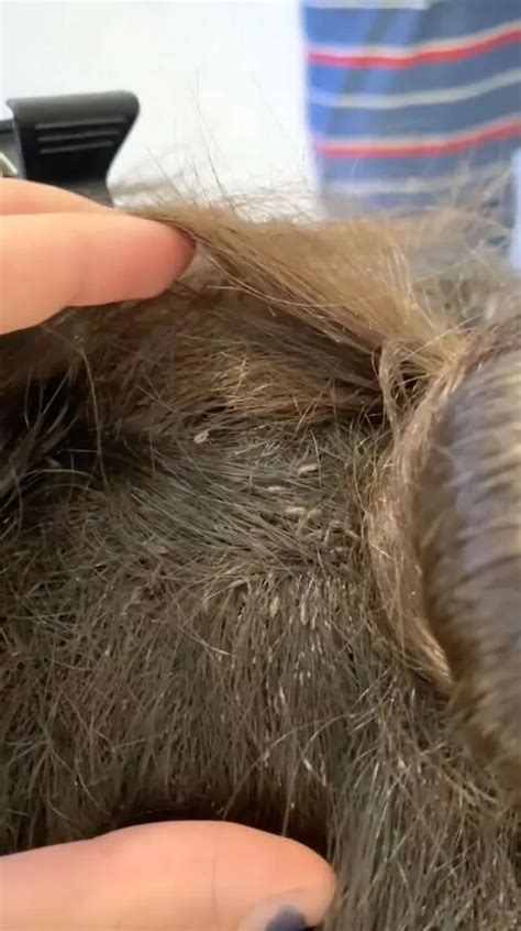 Girl had headlice so bad it took nine hours to get rid of them - CoventryLive