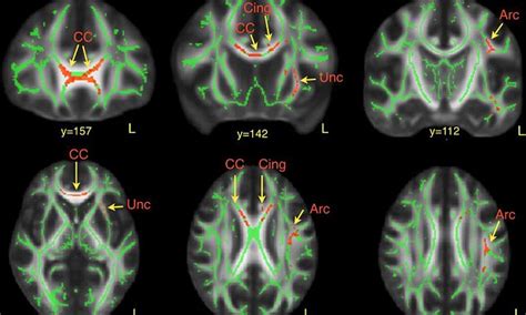 Scans of autistic brains reveal differences involved in language and facial recognition | Daily ...