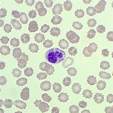 Toxic Granulation of Neutrophils | Test Findings - MedSchool