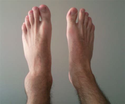 File:Sprained ankle 30min.jpg - Wikipedia