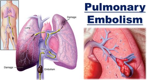 What Is Pulmonary Embolism Causes Symptoms Treatment And Prevention | Hot Sex Picture