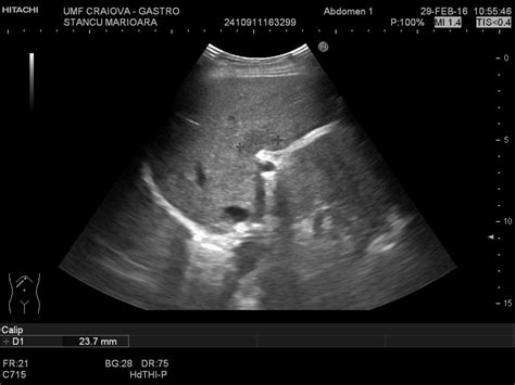 Focal fatty sparing of the liver [1 images] – EFSUMB