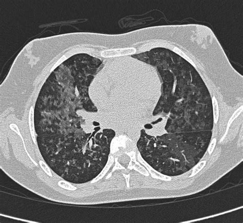 Hypersensitivity pneumonitis causes, symptoms, diagnosis, treatment & prognosis