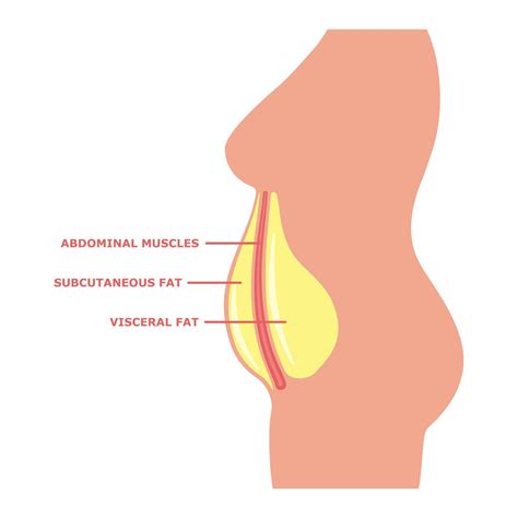 Visceral Fat Vs. Subcutaneous Fat: Will Lipo Help Either?