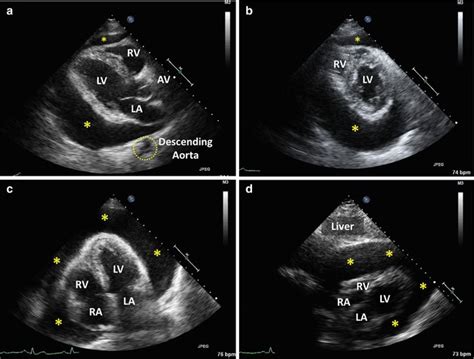 Pericardial Effusion Echo