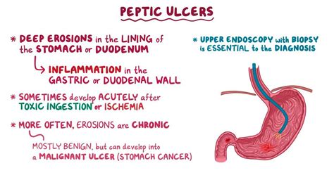 Peptic ulcers and stomach cancer: Clinical: Video | Osmosis