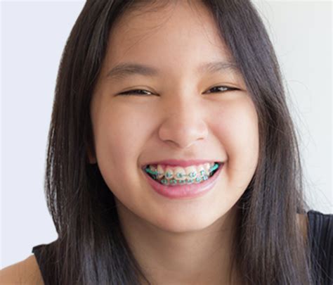 What Are Braces Power Chains? - Orthrodontic