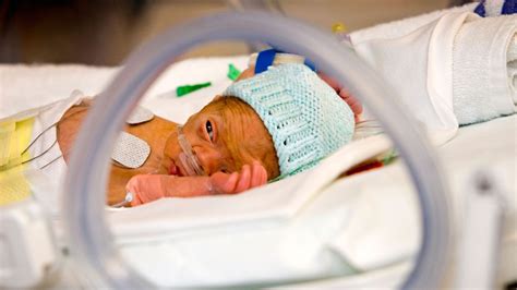 Extremely Preterm Babies Have Higher Risk of Eye Problems as Adults | MedPage Today