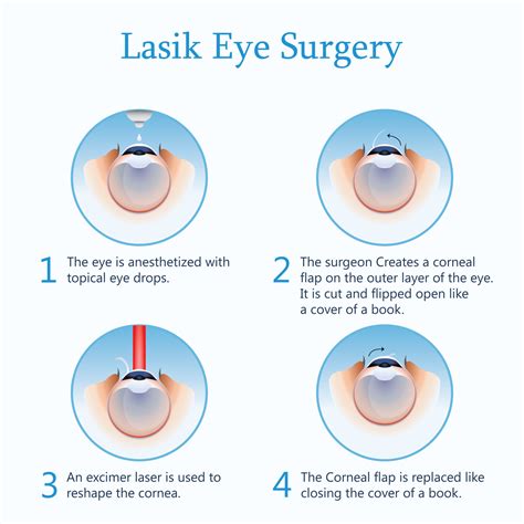 How Long Does Lasik Last For? - Tucson Optometry Clinic