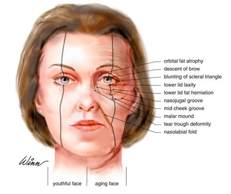 What is an Eye canthal Tilt? Why is a positive tilt more attractive ...