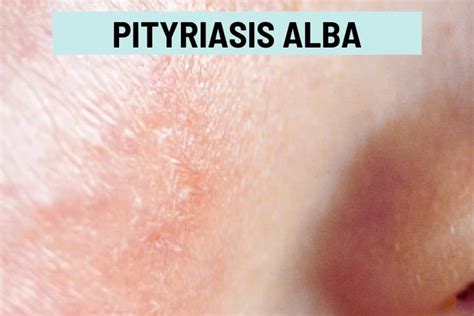 Pityriasis Alba: What causes these dry white patches on skin?