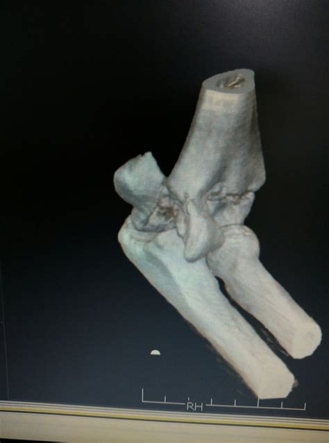 Humerus Trochlea Fracture – Orthoblogs