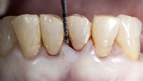 Tips on Periodontal Probing