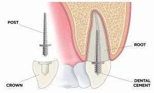 » What is a Dental Post?